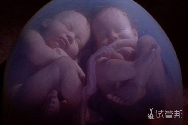 异卵双胞胎概率有多大