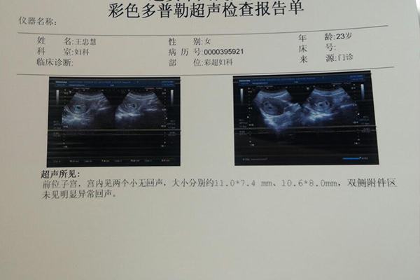 西宁市第一人民医院做试管婴儿怀双胞胎