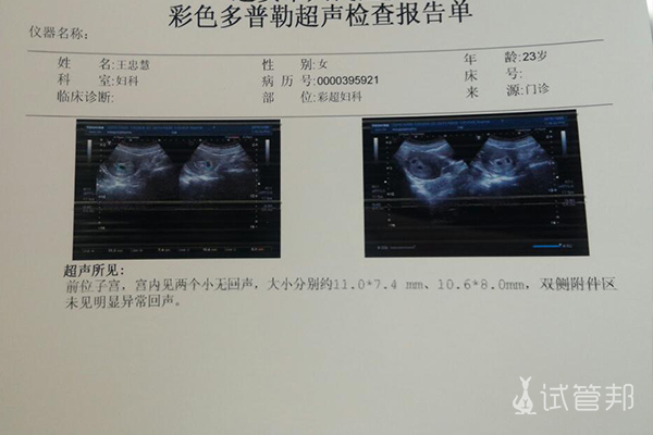 西宁市第一人民医院做试管婴儿怀双胞胎