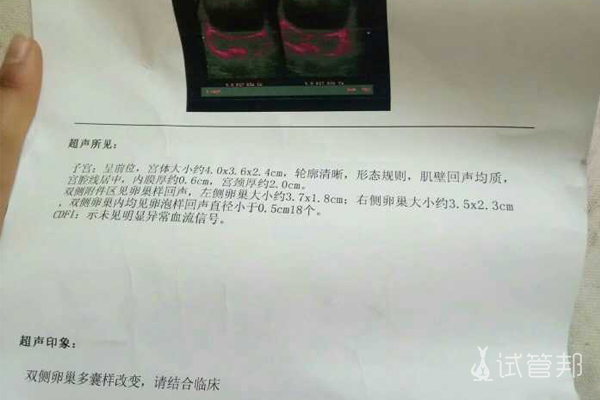 e12084a685953f0d37083c37c6354daf.jpg 多囊卵巢综合征