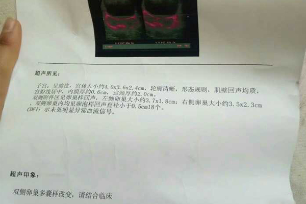 5b1956c647be752d9bcf7fbb16ac93bd.jpg 多囊卵巢做试管婴儿成功率高吗