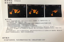 双侧卵巢囊肿，吉林省妇幼保健院试管婴儿终于好孕啦