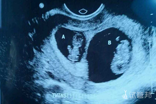 广州荔枝湾医院做试管婴儿怀上双胞胎