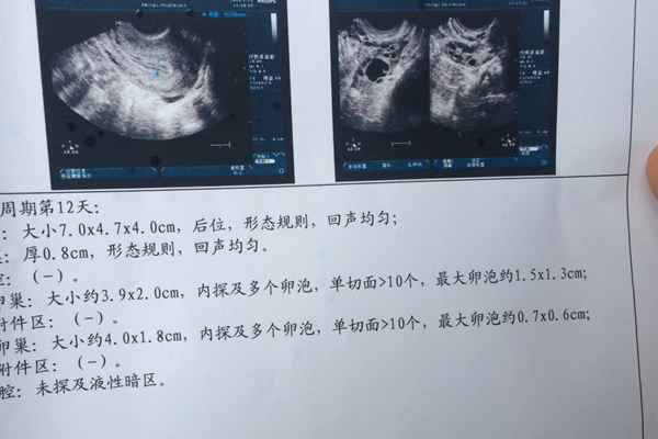 多囊卵巢可以做试管婴儿吗