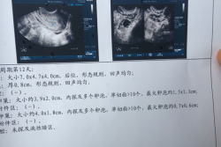 30岁多囊怀不上，河南省妇幼保健院试管婴儿经历