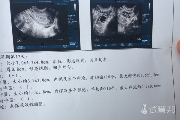 吉林省人民医院试管婴儿促排卵