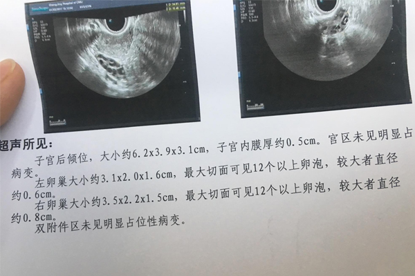 多囊卵巢做试管婴儿成功率高吗