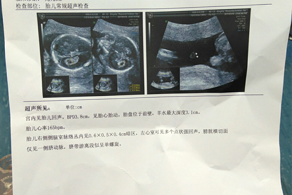 27岁反复流产只能选择做试管婴儿