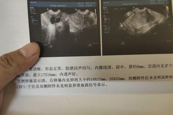 双侧输卵管切除还能做试管婴儿吗