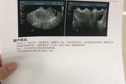 月经异常导致多年不孕，二代试管婴儿求子成功