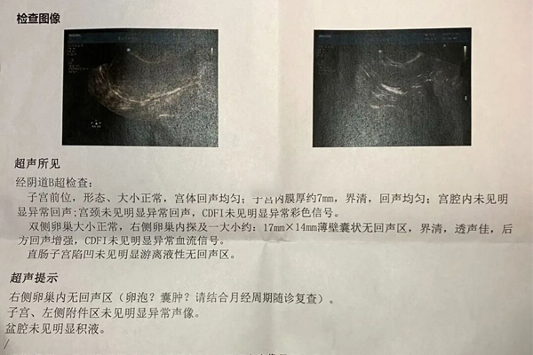 监测卵泡b超单怎么看