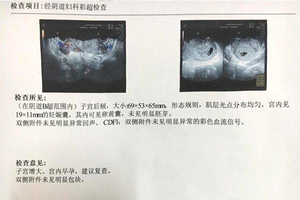 胎停育是什么原因导致的