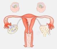 卵巢炎能自愈吗？