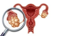 卵巢畸胎瘤影响怀孕吗？