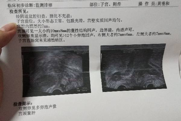 粤北人民医院试管婴儿促排卵结束，希望一切顺利