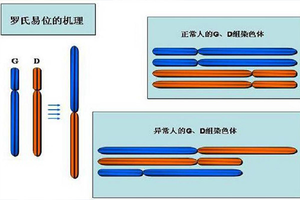 罗氏易位能做第三代试管婴儿吗