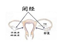卵巢性闭经包括哪些？