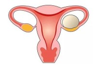 卵巢畸胎瘤要忌口吗？