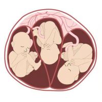 多胎妊娠的风险有哪些？