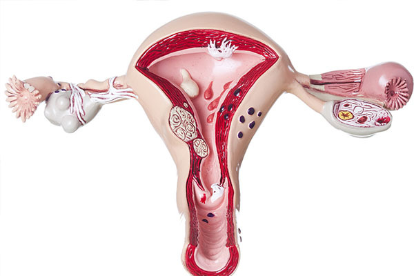 子宫肌瘤影响不孕不育
