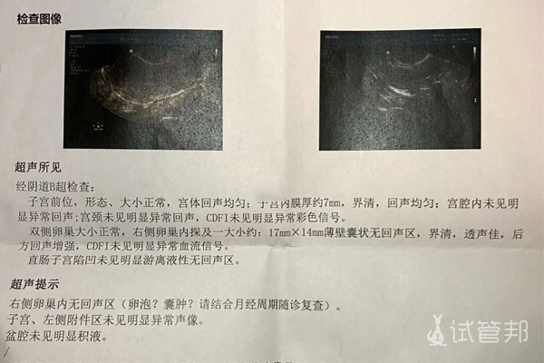 3cc2b24eaf853445a090afa3bb97f34f.jpg 试管婴儿移植前卵泡监测