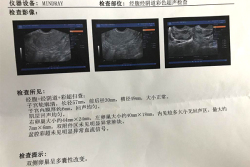 多囊卵巢备孕失败，选择试管婴儿迎来好孕