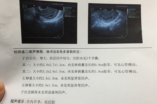 试管婴儿双胞胎b超