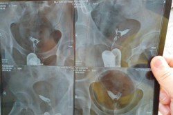 在南部战区总医院做二代试管婴儿成功，分享好孕气