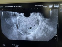 双侧卵巢囊肿诱发不孕，选择二代试管婴儿终于成功啦