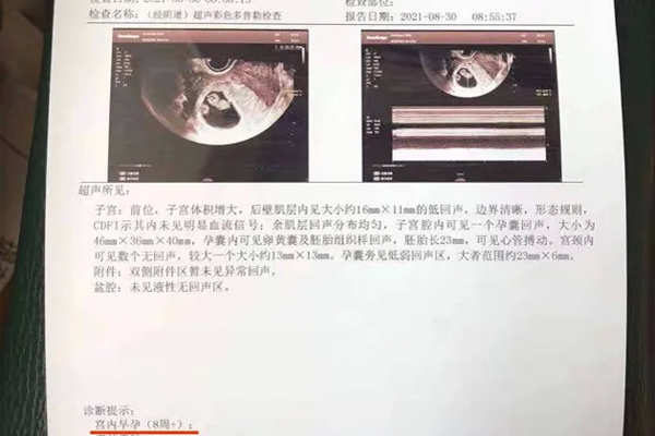 久坐导致巧克力囊肿决定在河北唐山市中医医院试管婴儿