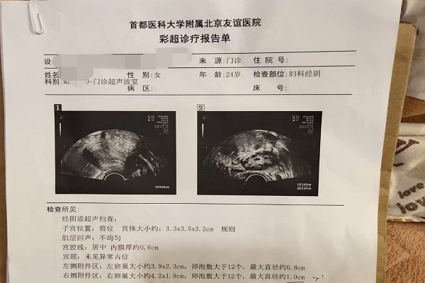 多囊促黄体生成素高不孕