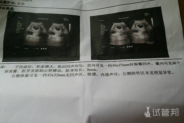 2b5e82e3f30e2697106446ac70a55574.jpg 高龄二胎计划试管婴儿怀双胞胎