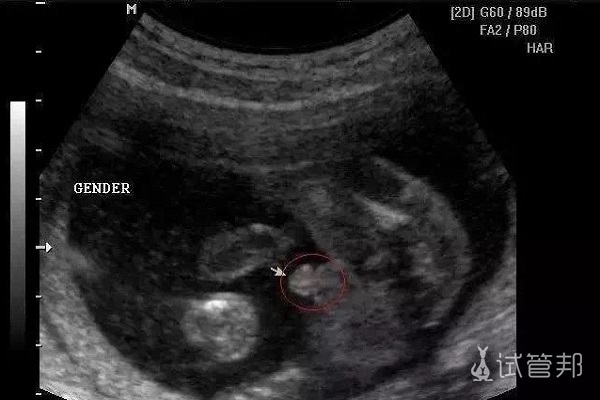 早孕B超检查