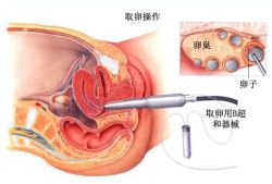 在台湾做试管婴儿取卵过程是怎样的？