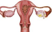 患有卵巢畸胎瘤，平时要注意些什么？