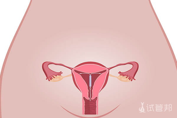 19415cd3d578b1d78781680cc22737ba.jpg 曼月乐脱落怎么处理