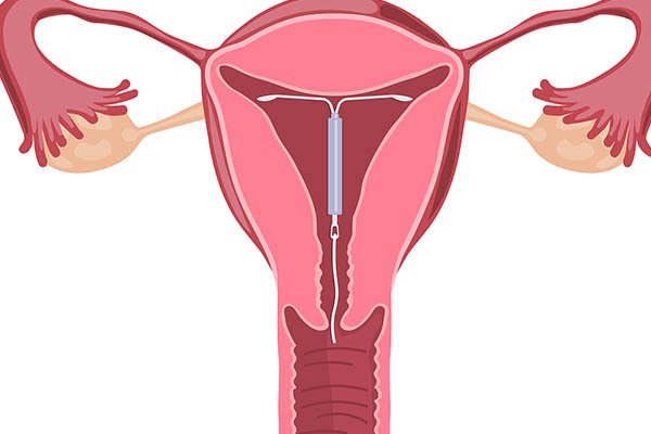 e8a90616261c2c41ed6886e88ac1fa21.jpg 曼月乐脱落怎么办