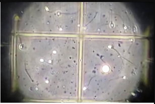 2bd05e7b0352f1b842323f4ad64a8bf0.png 逆行射精只能做试管治疗吗