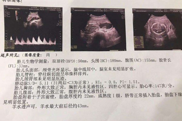 胎盘成熟度1级是什么意思