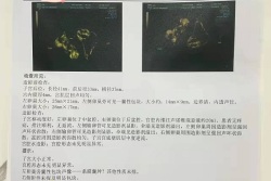 在咸阳市妇幼保健院，做输卵管造影的详细经过