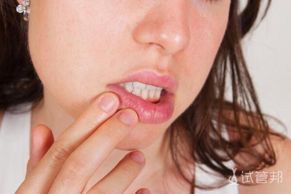 口腔念珠菌感染能自愈吗
