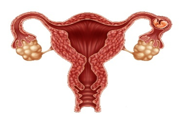 多囊卵巢综合症如何治疗及注意事项