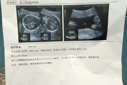 金华人民医院试管婴儿移植后着床成功，个人经验分享