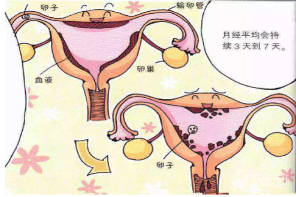 卵巢巧克力囊肿是什么