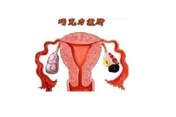 卵巢巧克力囊肿有什么注意事项