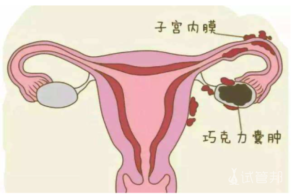 卵巢巧克力囊肿的症状有哪些