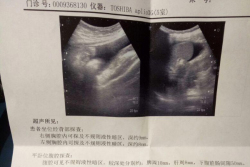 因输卵管堵塞在伊犁州妇幼保健院做试管婴儿 可惜失败了