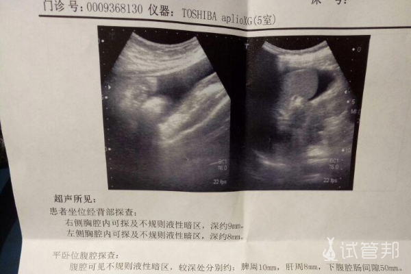 因输卵管堵塞在伊犁州妇幼保健院试管婴儿