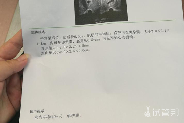 因输卵管堵塞在青岛大学附属医院试管婴儿幸得好孕