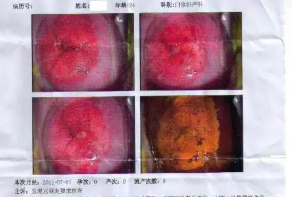 宫颈糜烂3度图片